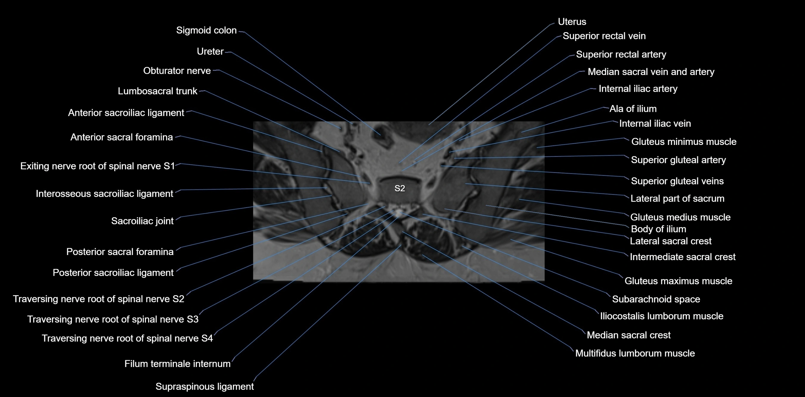 MRI sacrum, coccyx and sacroiliac joint axial cross sectional anatomy 3T  radiology  image-img-00001-00022.webp